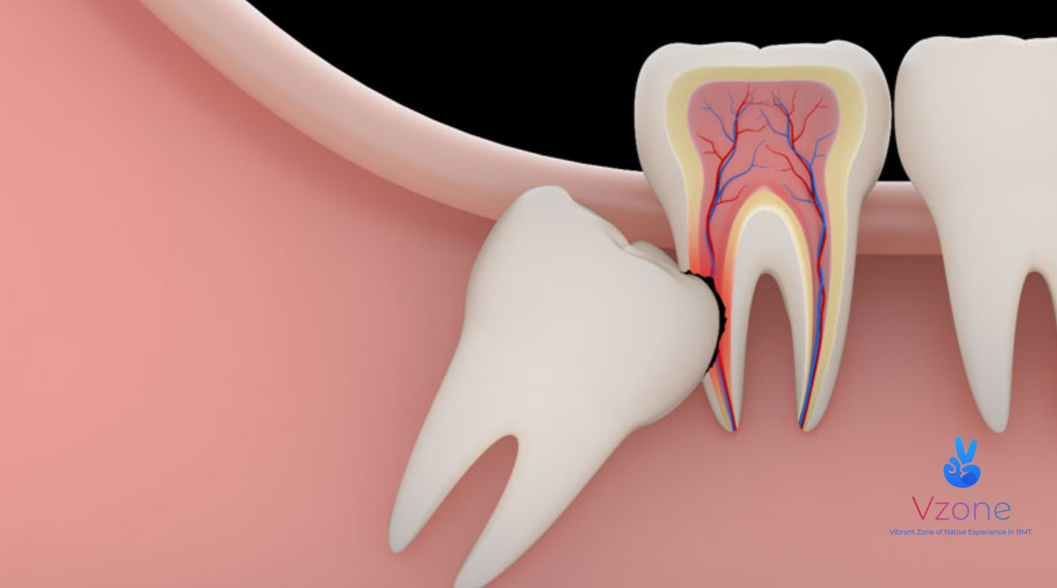 Khi nào cần nhổ răng khôn?