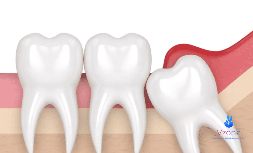 Quy trình nhổ răng khôn diễn ra như thế nào?