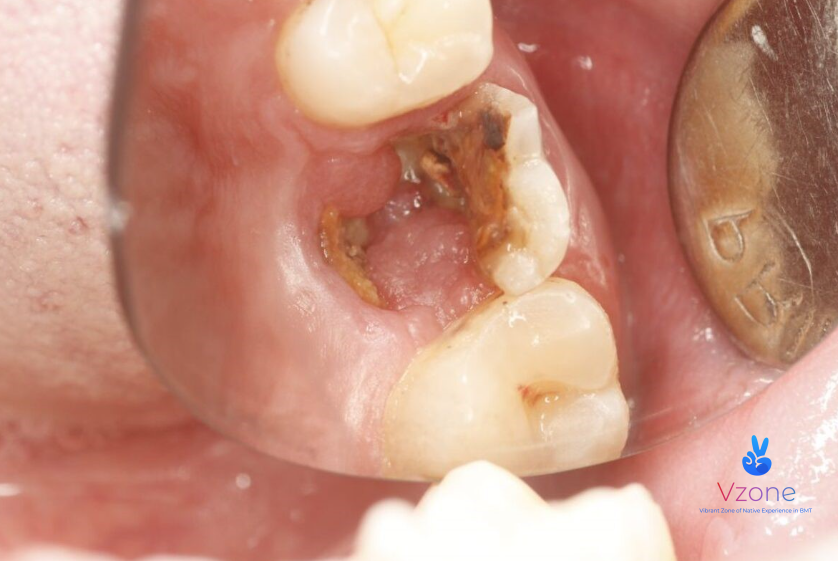 Quy trình trám răng sâu diễn ra như thế nào?