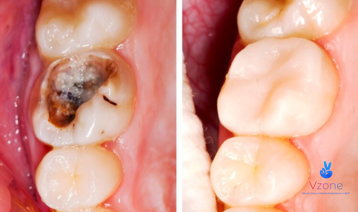 Răng sâu và các mức độ cần điều trị