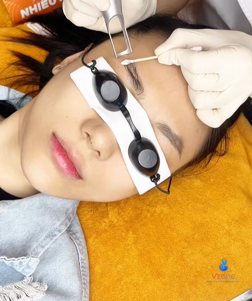 Khi nào cần xóa xăm chân mày?