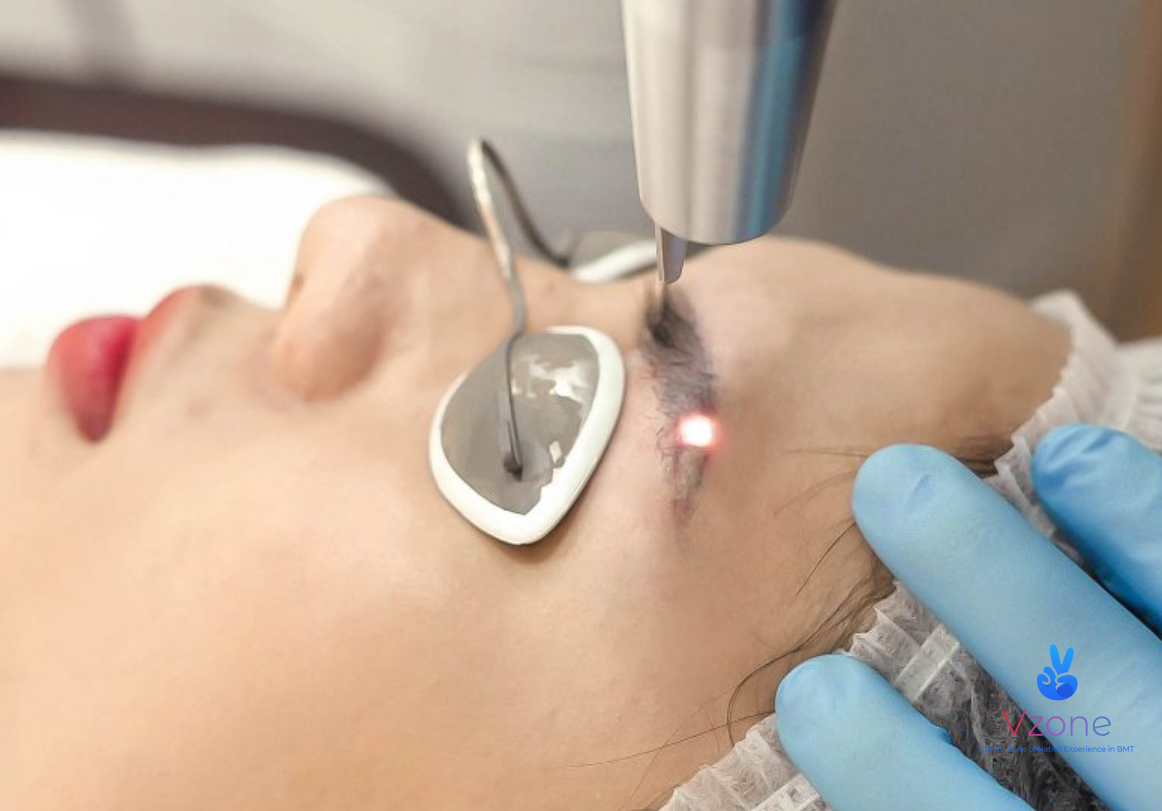 Nguyên lý hoạt động của công nghệ xóa xăm laser