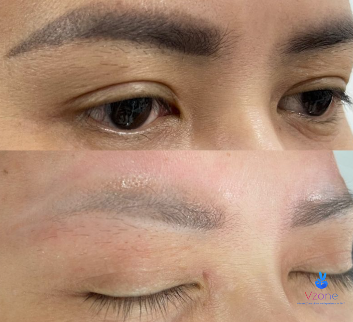 Quy trình xóa xăm chân mày bằng laser