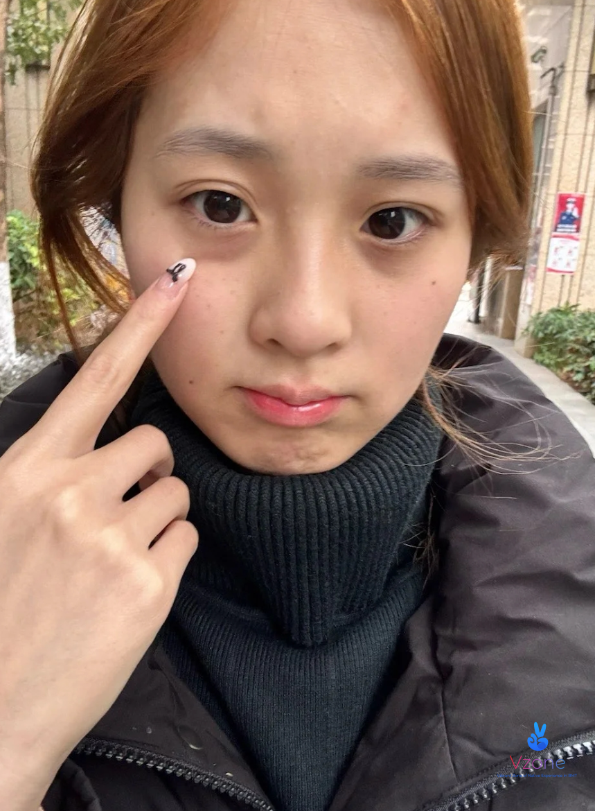 Vì sao người dân BMT hay bị thâm quầng mắt?