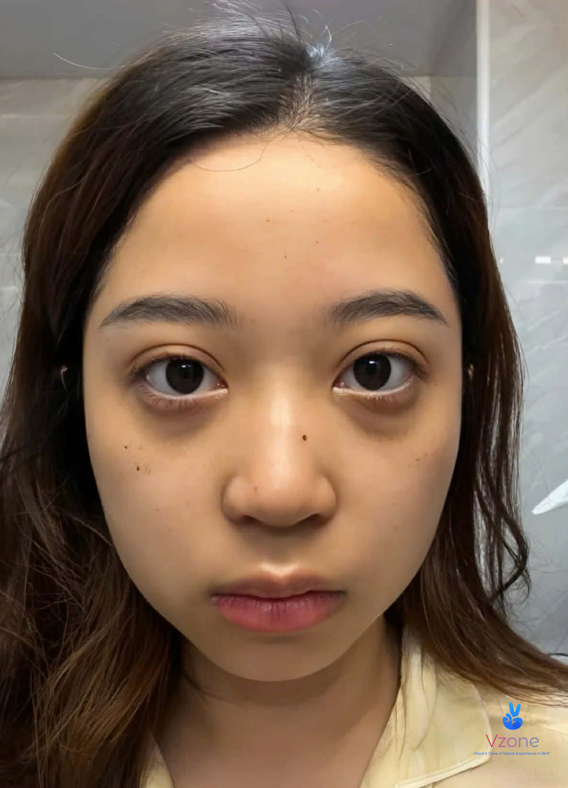 Vì sao người dân BMT hay bị thâm quầng mắt?